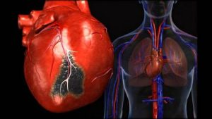 myocarditis 